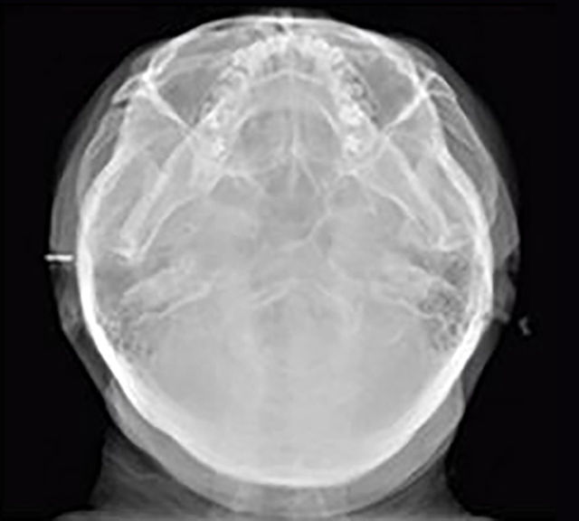 Radiografía SMV (Submentovertex)