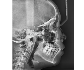 Radiografía OS(One Shot Standard)