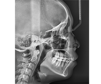 Radiografía OS(One Shot Standard)