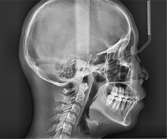 Radiografía OP (One Shot Premium)  30x25cm (12"x10")