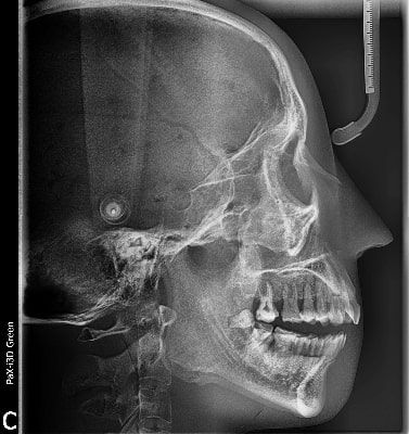 Pax-i 3D Green - Radiografía Ceph