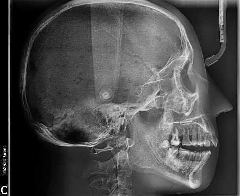 Pax-i 3D Green - Radiografía Ceph