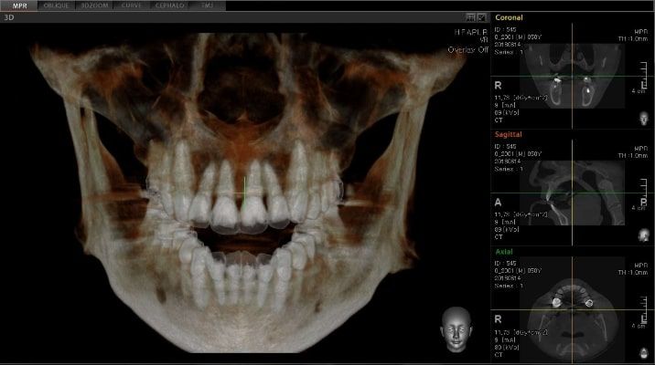 Pax-i 3D Green - Tomografía