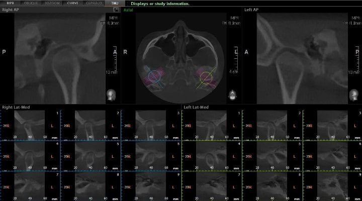 Pax-i 3D Green - Tomografía