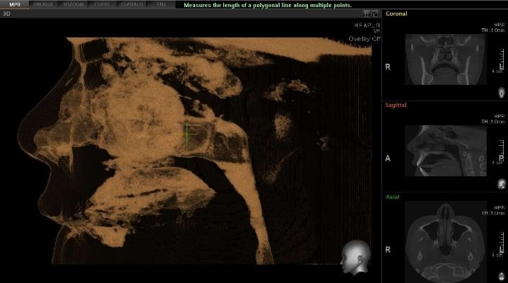Pax-i 3D Green - Tomografía
