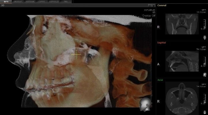 Pax-i 3D Green - Tomografía