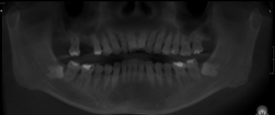 Pax-i 3D Green - Tomografía