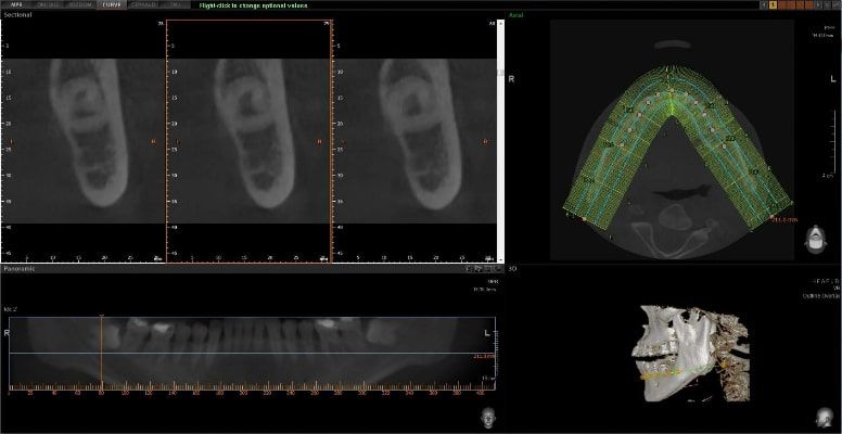Pax-i 3D Green - Tomografía