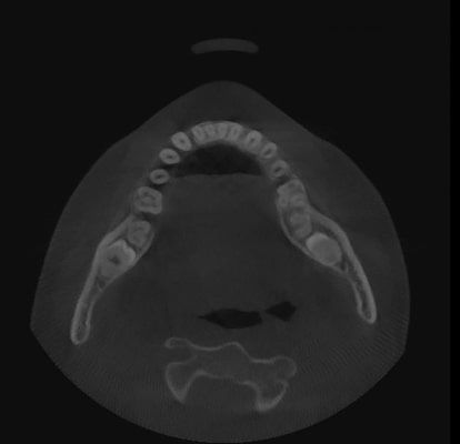 Pax-i 3D Green - Tomografía