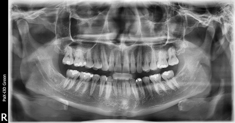 Pax-i 3D Green - Radiografía Panorámica