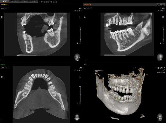 Pax-i 3D Smart- Tomografía