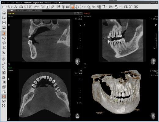 Pax-i 3D Smart- Tomografía