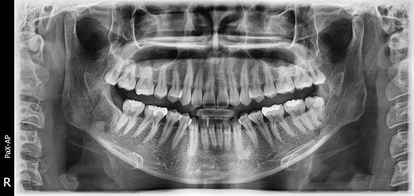 Pax-i 3D Smart - Radiografía Panorámica