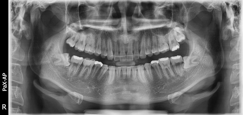 Pax-i 3D Smart - Radiografía Panorámica