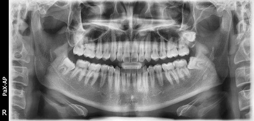 Pax-i 3D Smart - Radiografía Panorámica