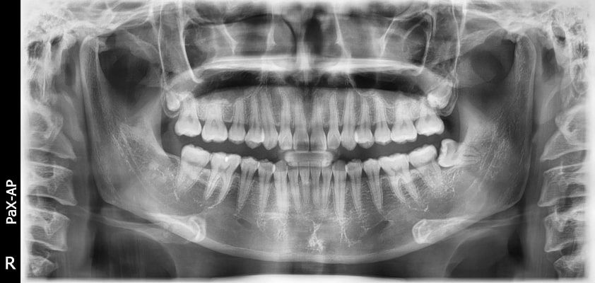 Pax-i 3D Smart - Radiografía Panorámica
