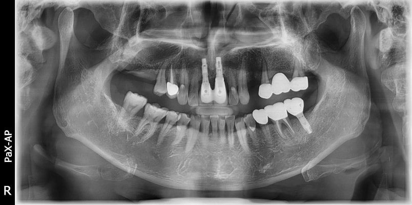 Pax-i 3D Smart - Radiografía Panorámica