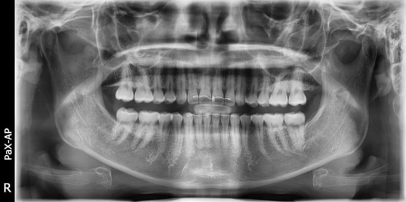 Pax-i 3D Smart - Radiografía Panorámica