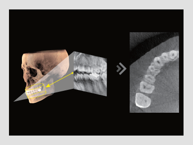 Pax-i 3D Smart - Reconstrucción de Imagen Normal