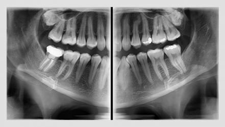 Radiografía Modo Aleta de Mordida - Bitewing Mode