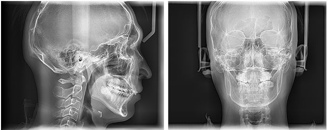 Radiografía con Sensor One Shot 